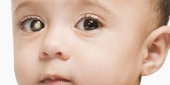 نسبة شفاء سرطان شبكية العين Retinoblastoma