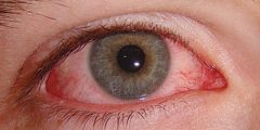 اسباب احمرار العين eye redness