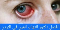 افضل دكتور التهاب العين في الاردن