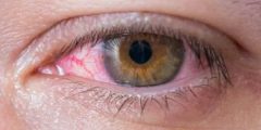 قطرة حساسية العين Eye allergy