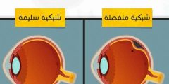 علاج انفصال الشبكية retinal degeneration