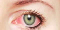 اسباب مرض الرمد eye illnesses symptoms