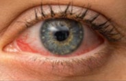 علاج مرض الرمد pink eye treatment