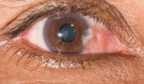 علاج ظفرة العين pterygium surgery
