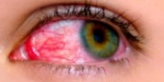 اسباب نزيف الشبكية retinal hemorrhage