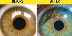 كيفية تغيير لون العيون change eye color surgery