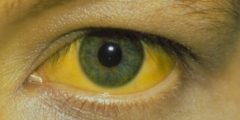علاج اصفرار العين eye treatment center