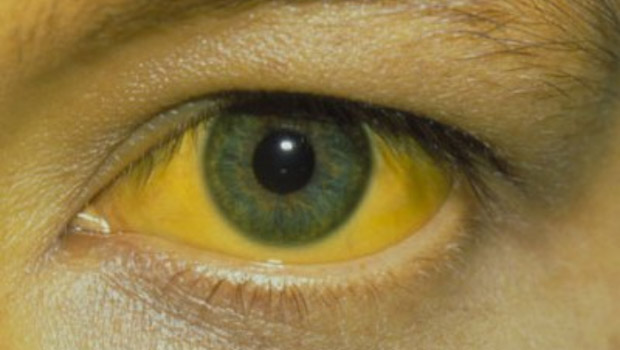 علاج اصفرار العين بالأعشاب
