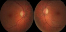 التهاب العصب البصري optic neuritis nhs