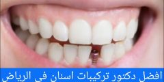 افضل دكتور تركيبات اسنان في الرياض